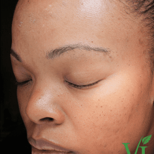 Before And After Facelift Photos Youthful Reflections Facelift Laser Skin Resurfacing Face Lift Surgery Plastic